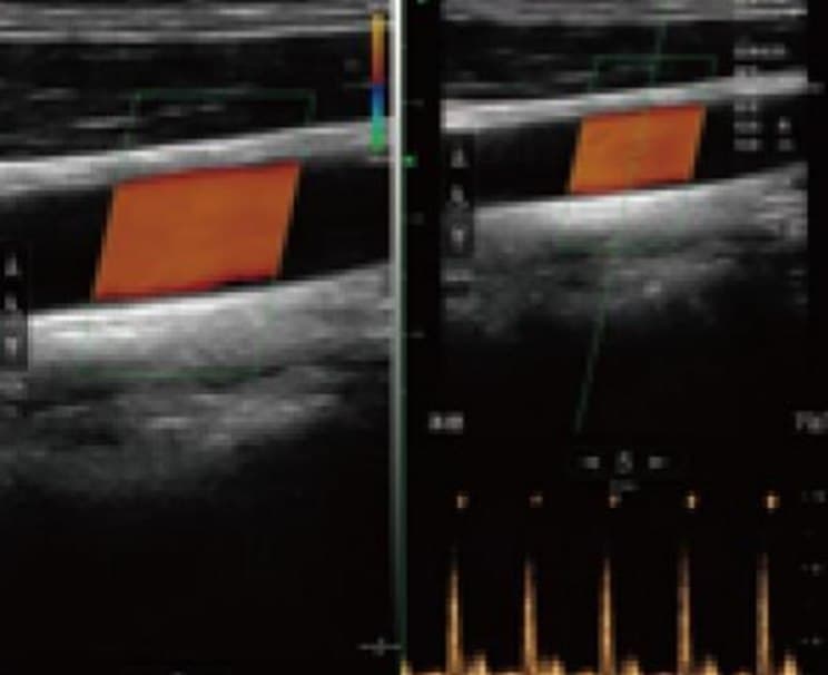 Artery scan with colour and pulsed wave Doppler from the linear array