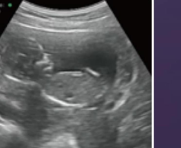 Early pregnancy scan from the convex array