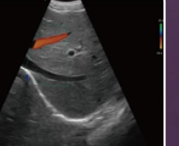 Liver scan with colour Doppler from the convex array