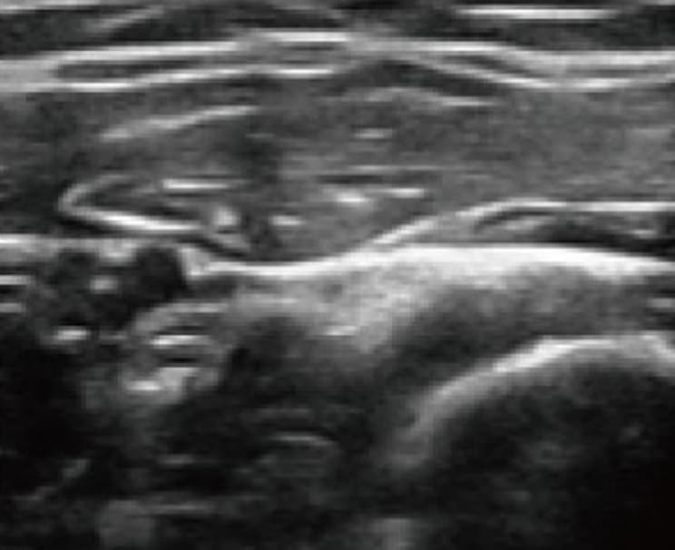 Musculoskeletal scan from the linear array